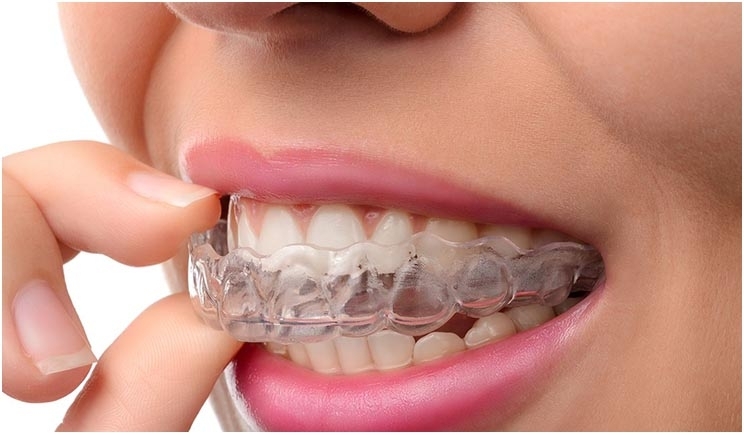 Aligner